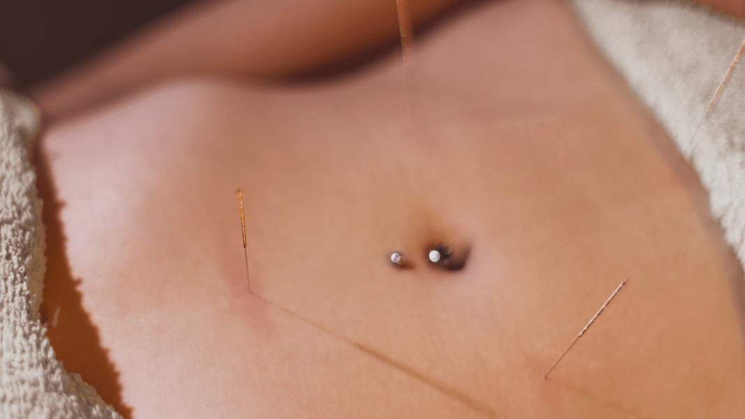 Acupuntura Doí?