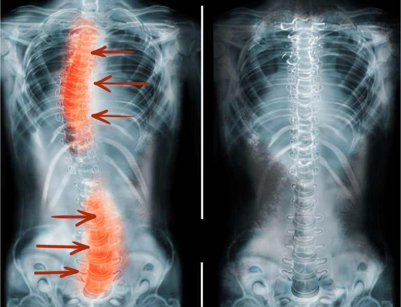 Coluna com escoliose x Coluna sem escoliose