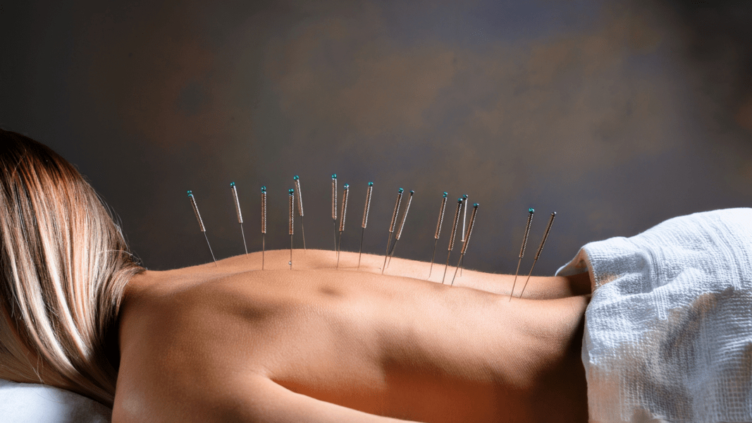 O Que É Acupuntura?