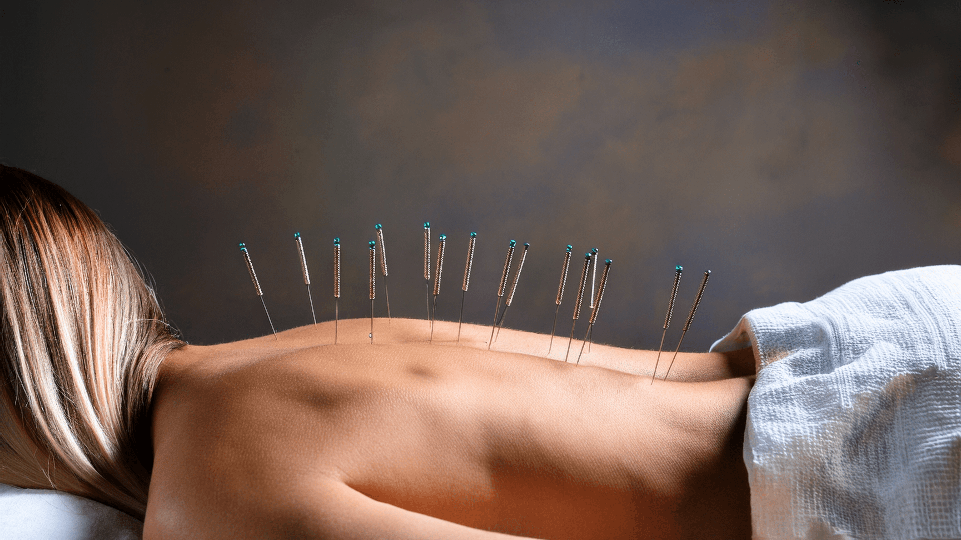 O Que É Acupuntura?