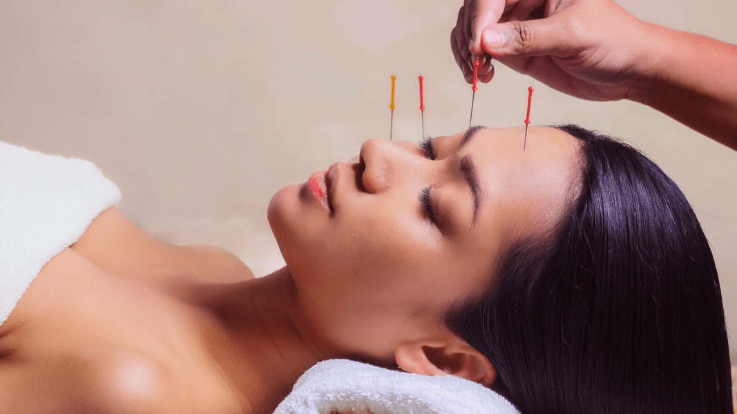 O Que Não Fazer Após Uma Sessão De Acupuntura
